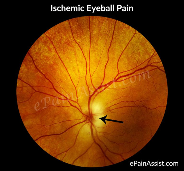Ischemic Eyeball Pain or Ocular Ischemic Syndrome (OIS) : Types, Symptoms, Treatment, Tests