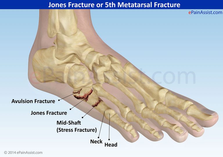 Jones Fracture or 5th Metatarsal Fracture: Causes, Symptoms, Treatment- Cast, Rehab