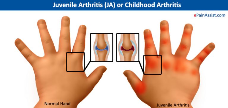 Juvenile Arthritis (JA) or Childhood Arthritis: Symptoms, Treatment- NSAIDs, PT
