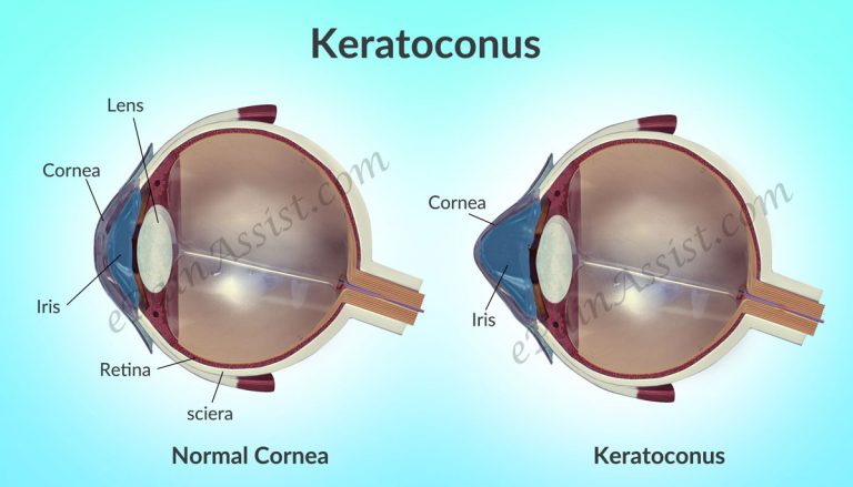 Know the Causes of Keratoconus and Its Treatment Using Lenses and Surgery