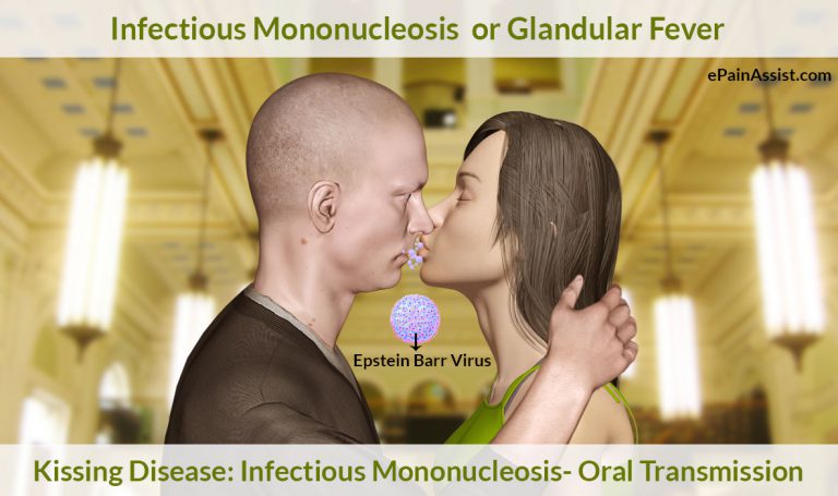 Infectious Mononucleosis (Mono) or Glandular Fever or Kissing Disease: Causes, Treatment