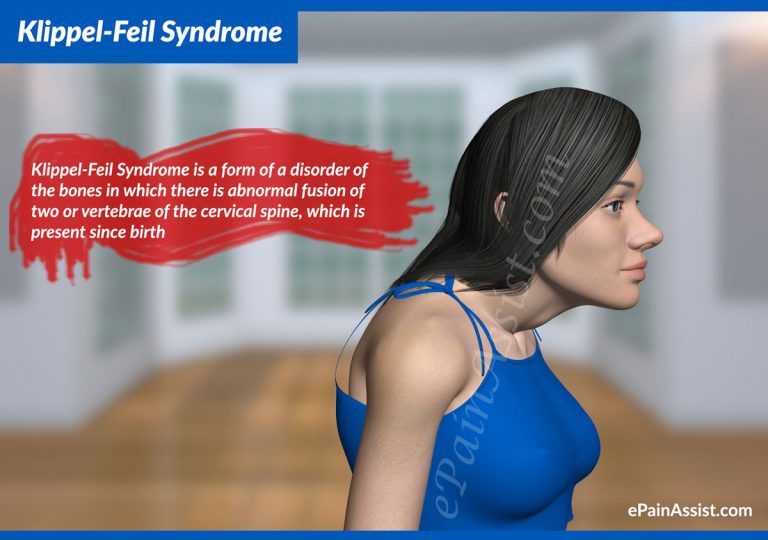 Klippel-Feil Syndrome: Causes, Classification, Symptoms, Signs, Diagnosis, Treatment
