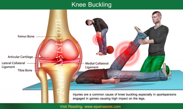 Knee Buckling: What Can Cause Knees To Buckle?