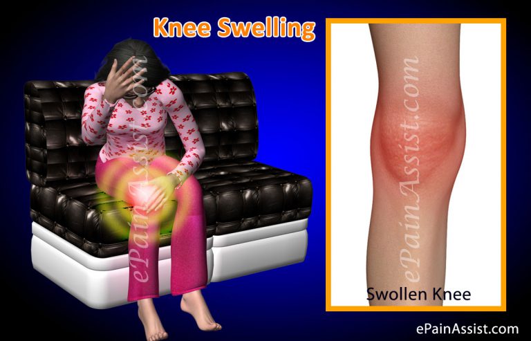 Knee Swelling or Swollen Knee: Symptoms, Causes, Diagnosis, Treatment