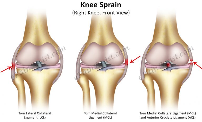 Knee Sprain: Classifications, Causes, Symptoms, Risk Factors