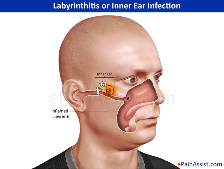 Labyrinthitis or Inner Ear Infection : Types, Symptoms, Treatment- Antihistamines