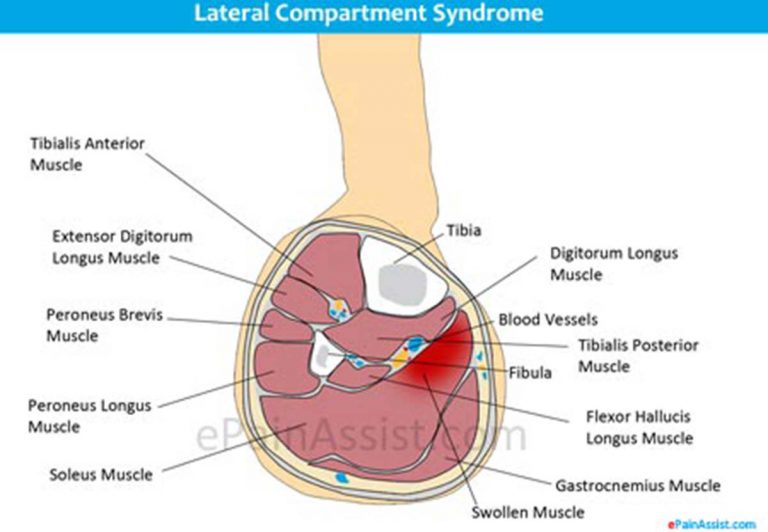 Lateral Compartment Syndrome: Acute, Chronic- Causes, Symptoms, Treatment