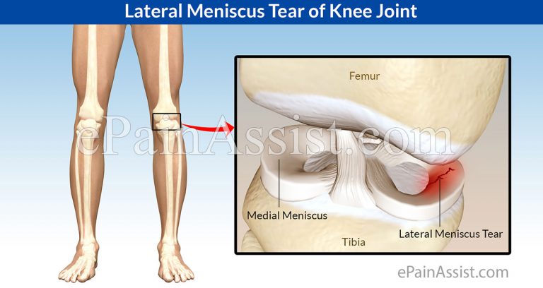 Lateral Meniscus Tear of Knee Joint: Types, Treatment- Conservative, Medications, Surgery