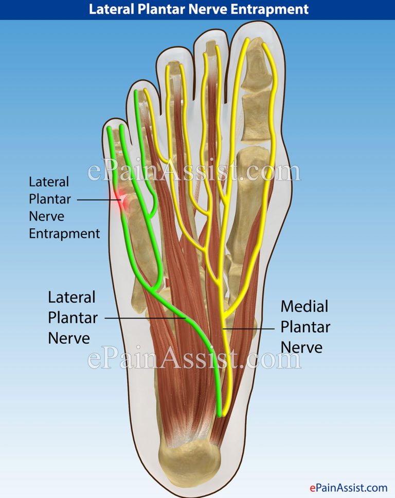Lateral Plantar Nerve Entrapment: Symptoms, Treatment- NSAIDs, Tape, Surgery