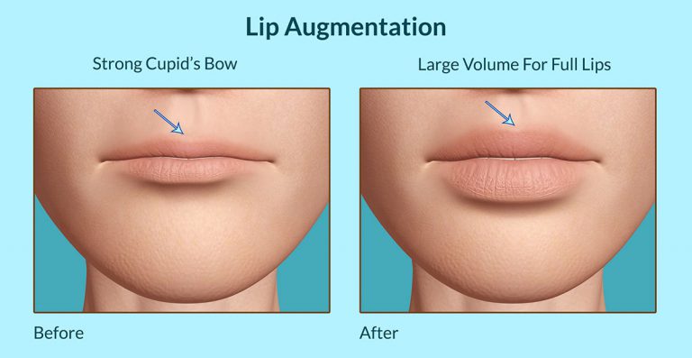 Lip Augmentation: Facts, Types, Pros, Cons, Should One Opt For It?