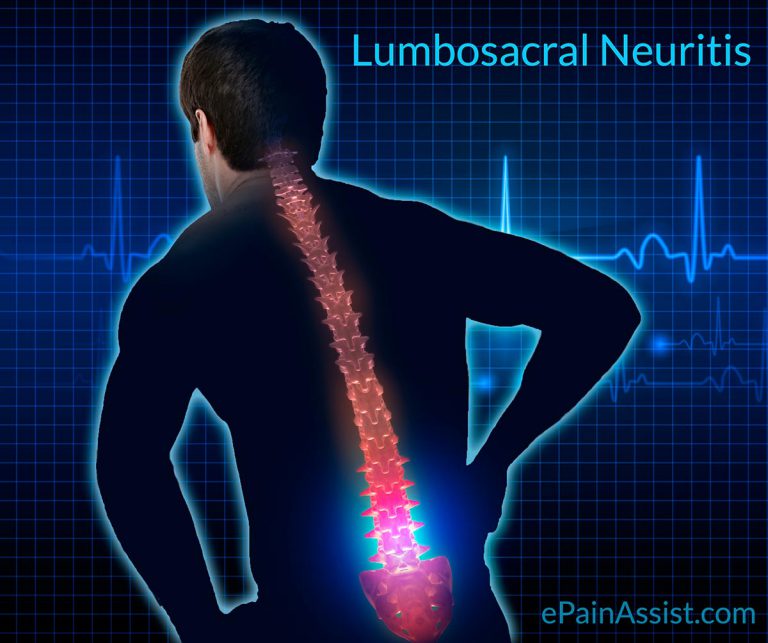 Lumbosacral Neuritis: Causes, Symptoms, Treatment, Home Remedies- Soya Bean, Barley Brew