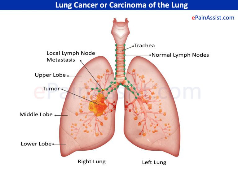 Lung Cancer or Carcinoma of the Lung: Causes, Types, Risk Factors, Symptoms, Signs, Investigations, Treatment, Stages