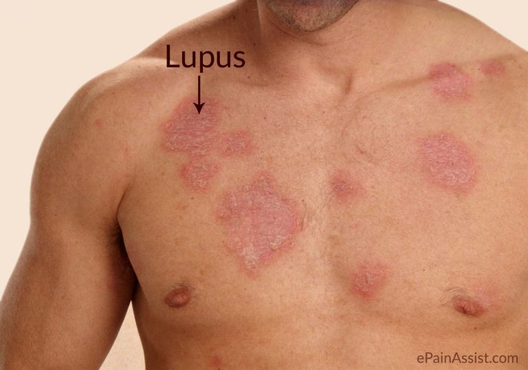 Lupus: Causes, Signs, Symptoms, Treatment, Lifestyle Modifications