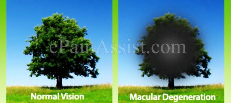 Dry Macular Degeneration : Stages, Causes, Symptoms, Signs, Treatment