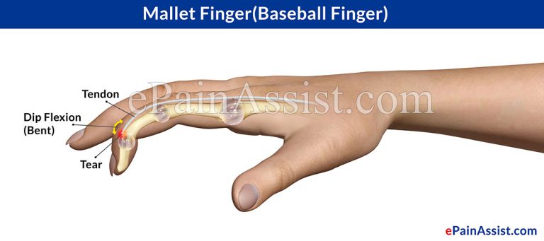 Mallet Finger or Baseball Finger: Causes, Symptoms, Treatment, Investigations