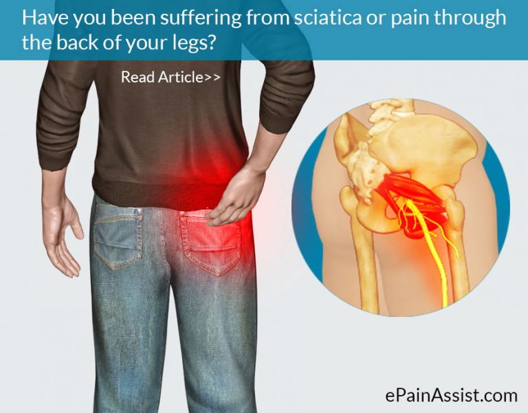 Manage Sciatica with 5 Simple Lifestyle Modifications: Proper Posture, Fitness, Nutrition
