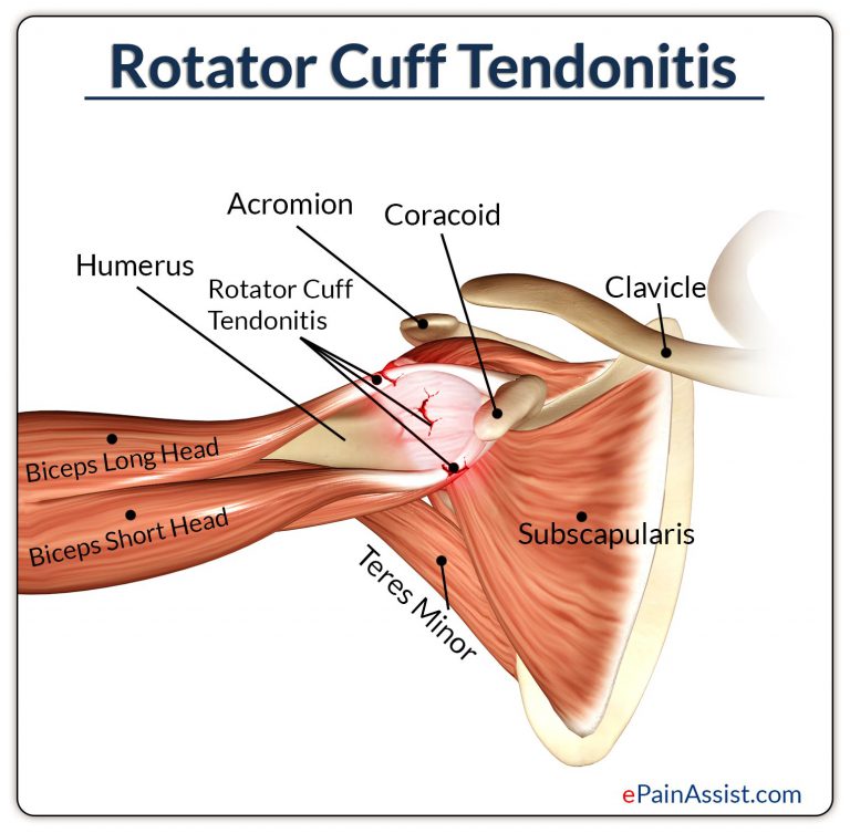 Massage Therapy for Rotator Cuff Tendonitis: Deep Tissue Massage, Deep Friction Massage