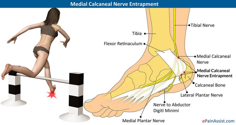 Medial Calcaneal Nerve Entrapment: Symptoms, Treatment- Rest, Cold Therapy, Massage