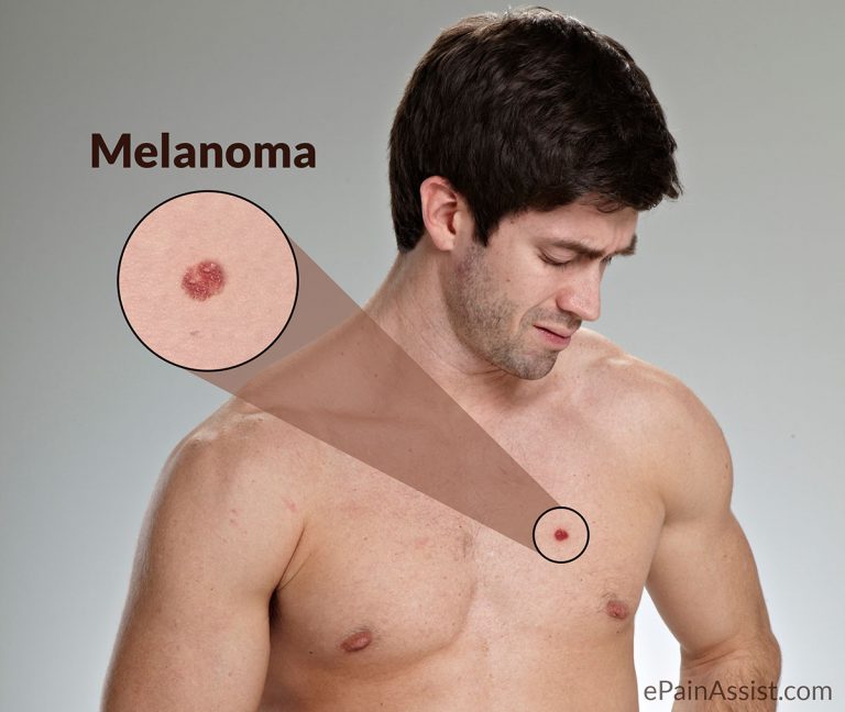 Melanoma: Causes, Risk Factors, Signs, Symptoms, Investigations, Stages, Treatment, Prevention