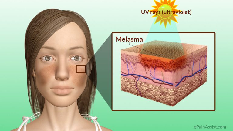 Melasma or Chloasma or Mask of Pregnancy: Causes, Location, Types, Treatment, Prevention