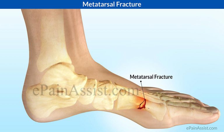 Metatarsal Fracture: Causes, Symptoms, Treatment