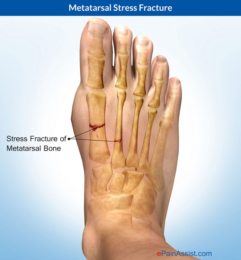 Metatarsal Stress Fracture: Symptoms, Causes, Treatment, Prognosis, Recovery