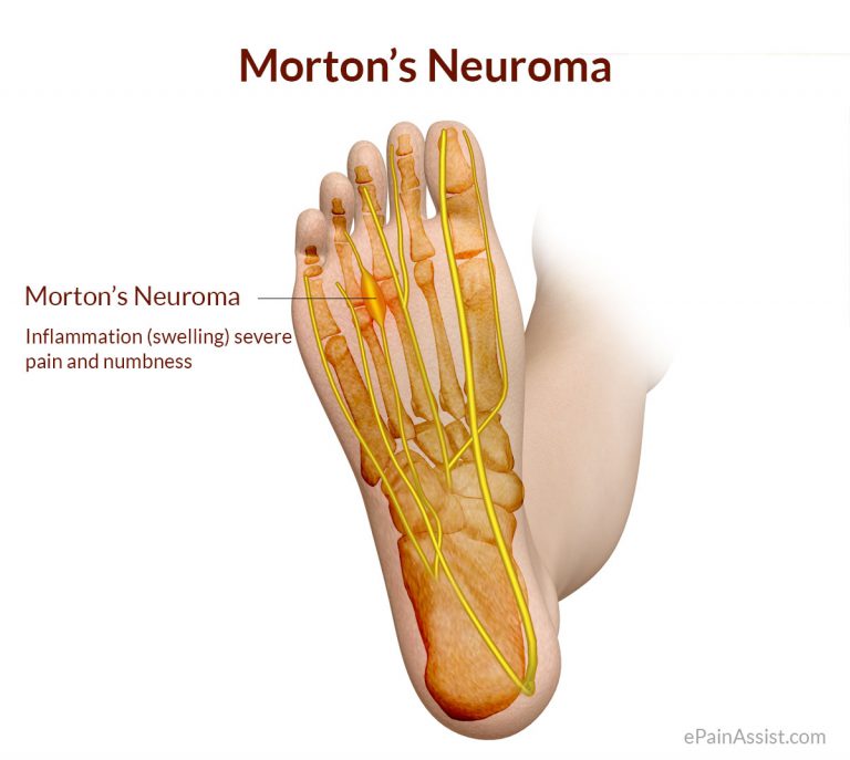 Morton’s Neuroma or Morton’s Metatarsalgia or Plantar Neuroma: Causes, Symptoms, Treatment