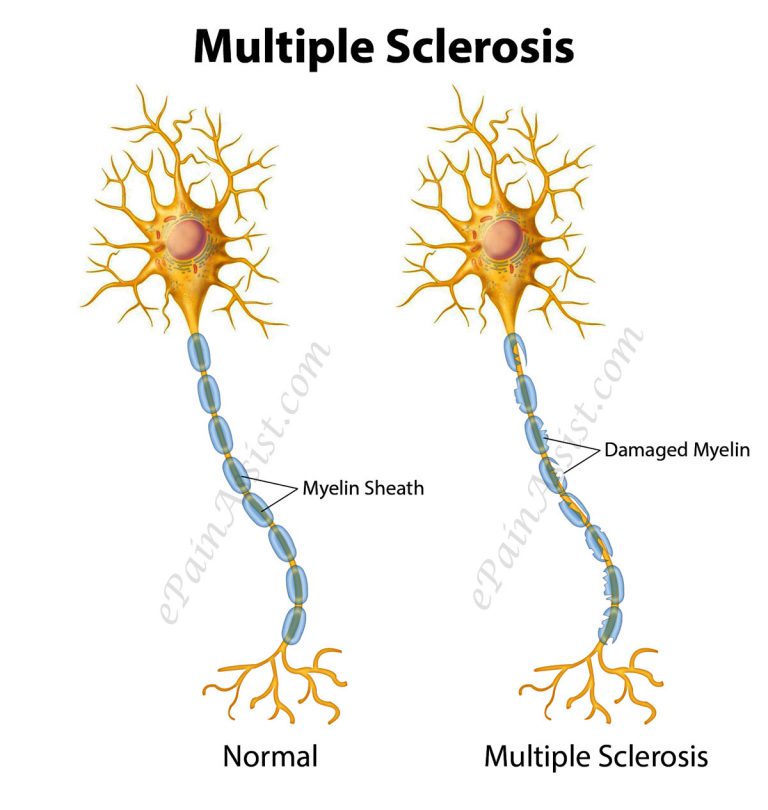 Multiple Sclerosis (MS) or Disseminated Sclerosis: Types, Risk Factors, Symptoms, Treatment