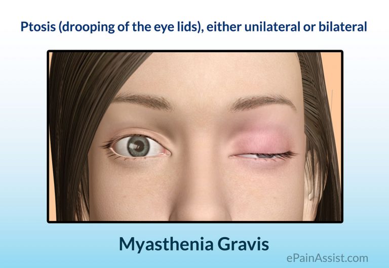 Myasthenia Gravis: Causes, Signs, Symptoms, Investigations, Treatment- Medications, Surgery