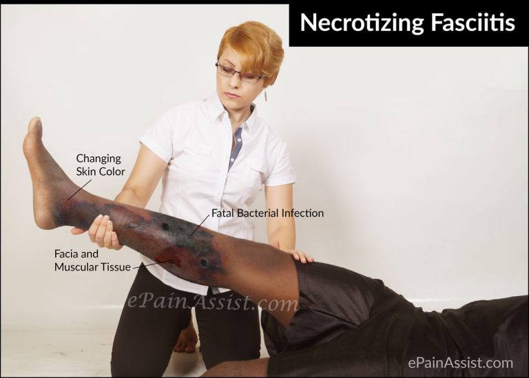 Necrotizing Fasciitis: Risk Factors, Causes, Signs & Symptoms, is it Contagious, Treatment, Prevention