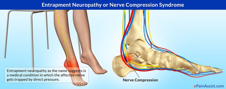 Entrapment Neuropathy or Nerve Compression Syndrome: Types, Causes, Symptoms, Treatment