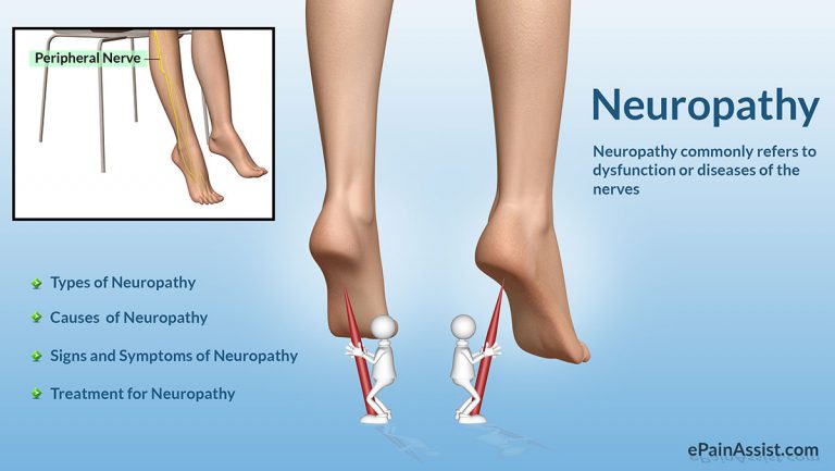 Neuropathy: Classification, Types, Causes, Risk Factors, Symptoms, Treatment, Investigations