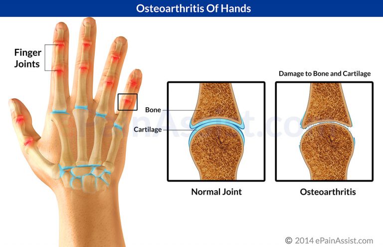 Osteoarthritis Of Hands: Risk Factors, Symptoms, Signs, Treatment- Medications, Surgery