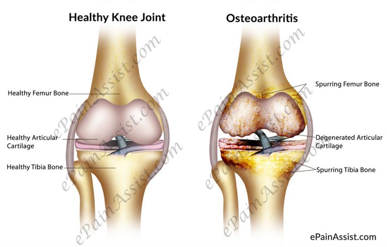 What is Osteoarthritis of the Knee & What are its Causes, Signs & Symptoms