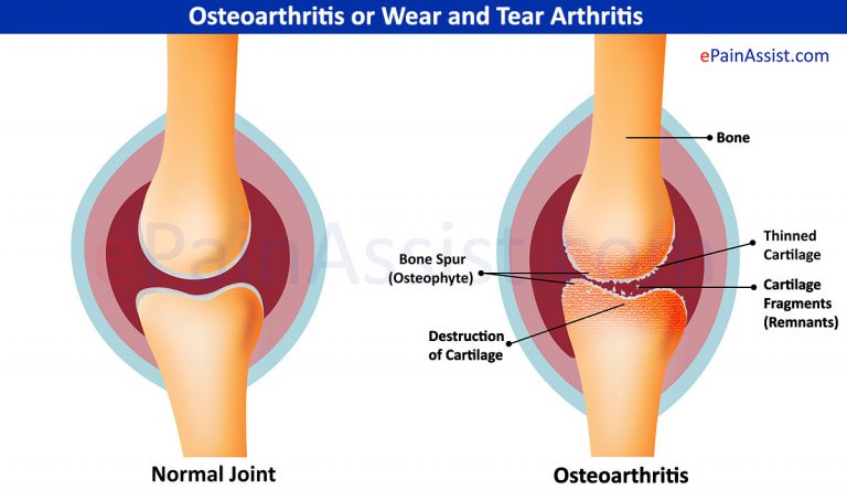 Osteoarthritis or Wear and Tear Arthritis: Types, Causes, Symptoms, Treatment- Surgery