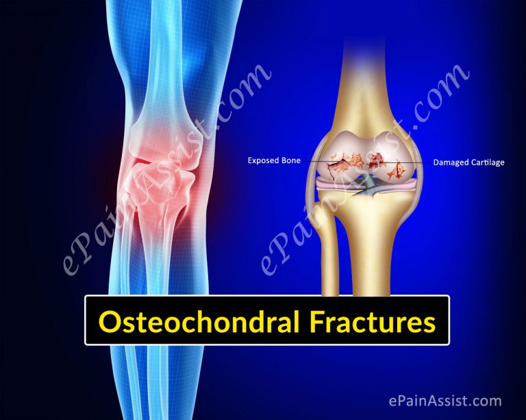 Osteochondral Fractures of Knee or Articular Cartilage Injury: Causes, Subchondral