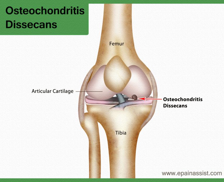 What is Osteochondritis Dissecans of Knee Joint and How is it Treated?