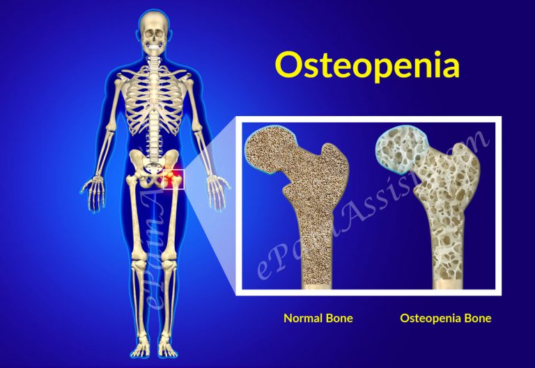 Osteopenia: Causes, Symptoms, Diagnosis, Treatment, Prevention