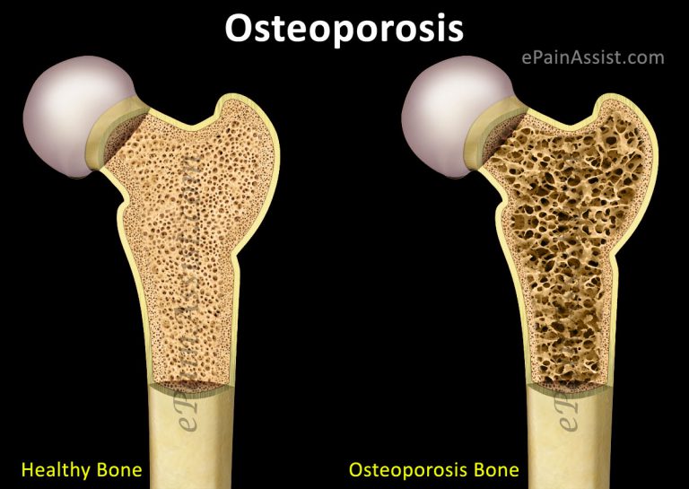 Osteoporosis: Causes, Risk Factors, Symptoms, Treatment, Home Remedies, Prevention