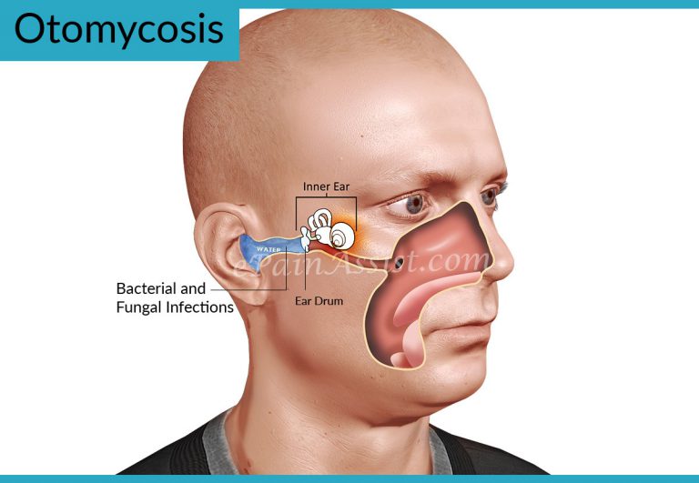 What is Otomycosis or Ear Fungus? Know Its Causes, Symptoms, Treatment, and Home Remedies