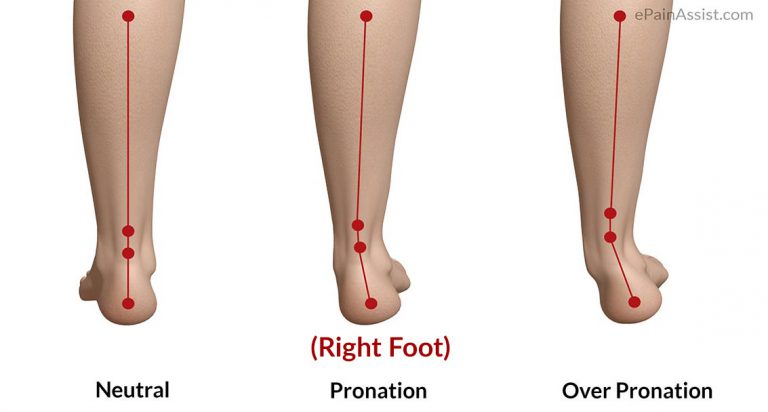 Overpronation of Foot: Mechanism of Injury, Diagnosis, Treatment- Gait Analysis, Orthotics