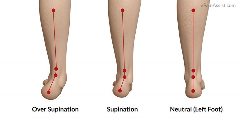 Oversupination of Foot: Mechanism of Injury, Diagnosis, Treatment- Gait Analysis, Orthotics