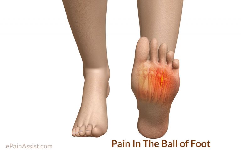 Pain in the Ball of Foot or Metatarsalgia: Causes, Symptoms, Treatment