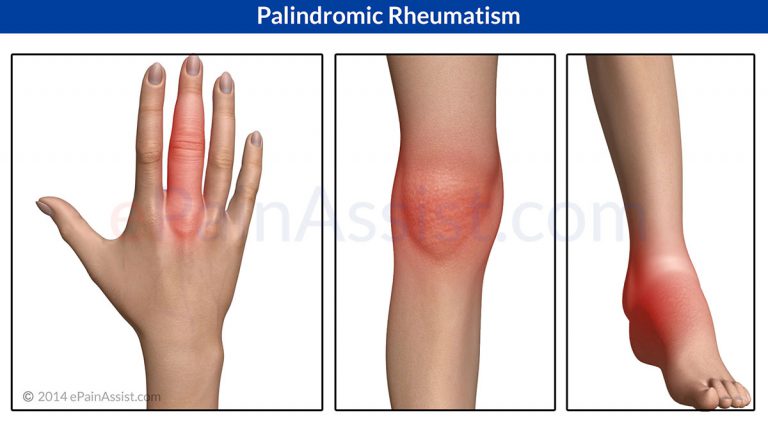 Palindromic Rheumatism or Palindromic Arthritis: Causes, Symptoms, Treatment, Prognosis