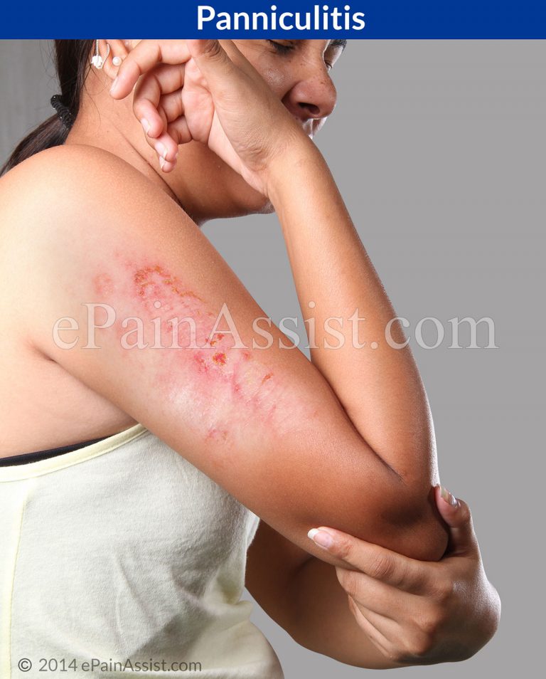 Panniculitis: Classification, Symptoms, Diagnosis, Treatment- NSAIDs, Tetracycline