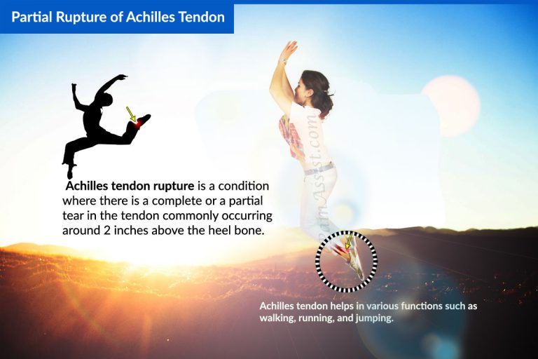 Partial Rupture of Achilles Tendon: Symptoms, Treatment, Exercises, Sports Massage