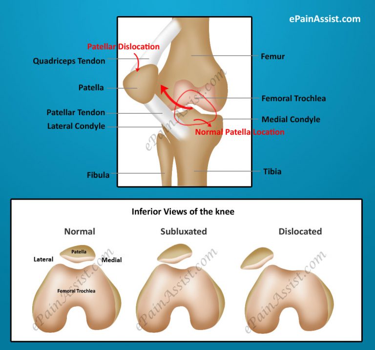 Causes & Symptoms of Patellar Dislocation or Kneecap Dislocation