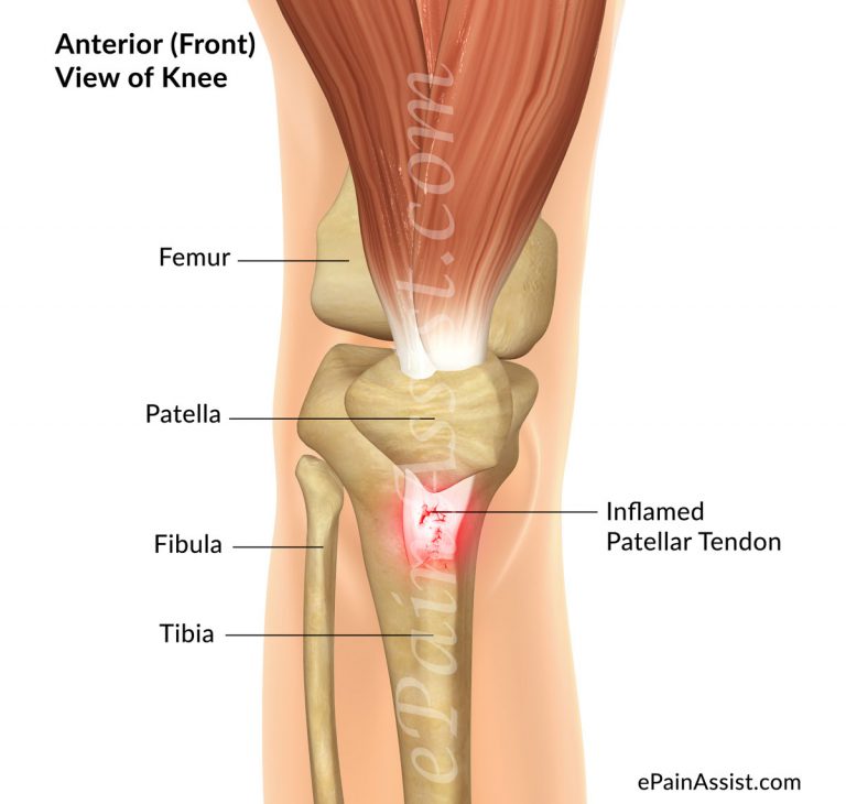 Patellar Tendinitis or Jumper’s Knee: Symptoms, Grades, Treatment- Knee Support