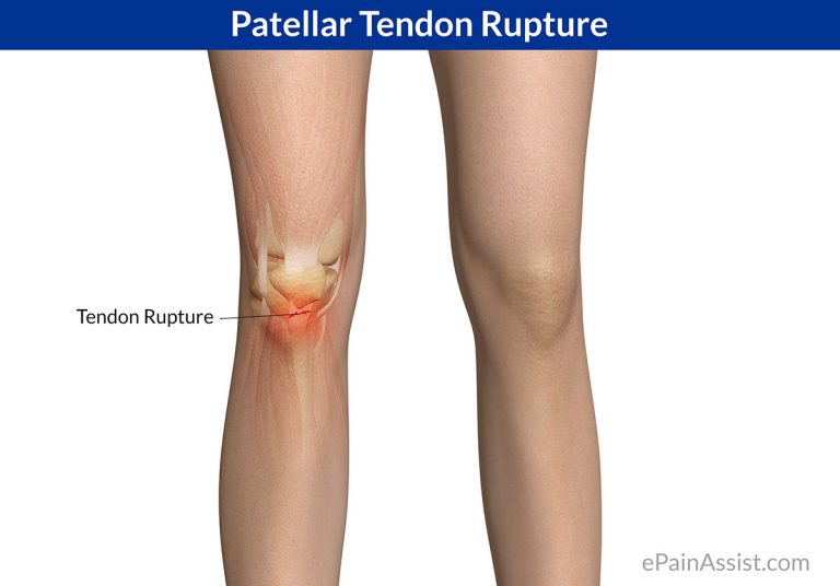 Patellar Tendon Rupture or Patellar Tendon Tear: Causes, Symptoms, Treatment, Prognosis, Recovery