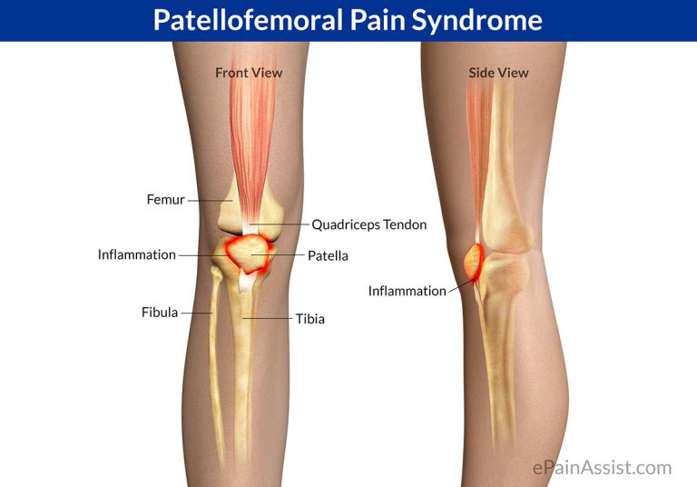 Patellofemoral Pain Syndrome (PFPS): Causes, Symptoms, Treatment, Recovery, Exercises, Surgery